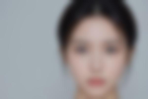 江苏宿迁沙俊丽医生双眼皮隆鼻技术好,沙俊丽玻尿酸价格亲民成效自然!