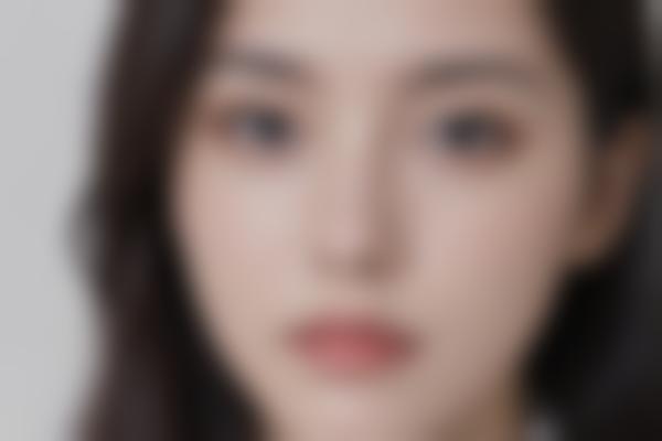 春燕医生眼部整形怎么样？