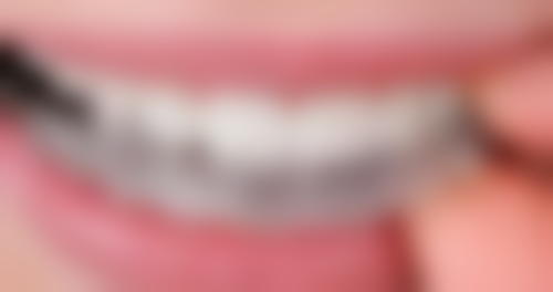 乌鲁木齐美奥口腔根管治疗前：专精诊断与方案制定