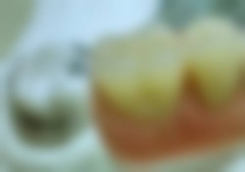 根尖问题：根管治疗的“紧急信号”