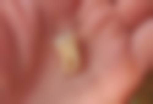 玻璃离子与其他补牙材料大比拼