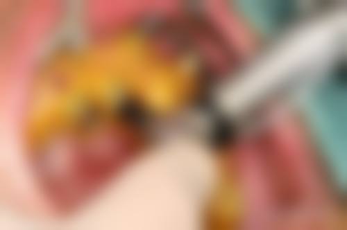 {永州全口种植24小时在线咨询，中南口腔唐青砖主刀，全口6万起无套路！ 