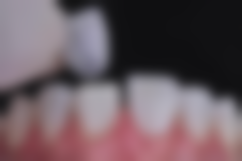 不休息可能引发的根管治疗后问题