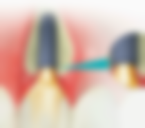 老人骨质疏松种植牙有哪些技术助力？