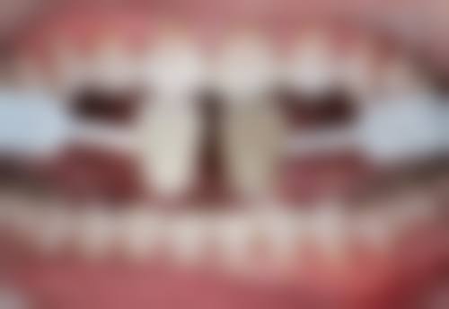 术后护理：促进修复减少疼痛困扰