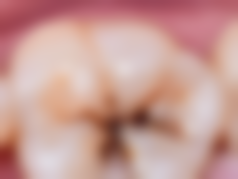 补牙后的注意事项及日常护理