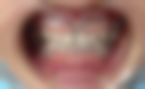 不同补牙材质价格对比：按需选择