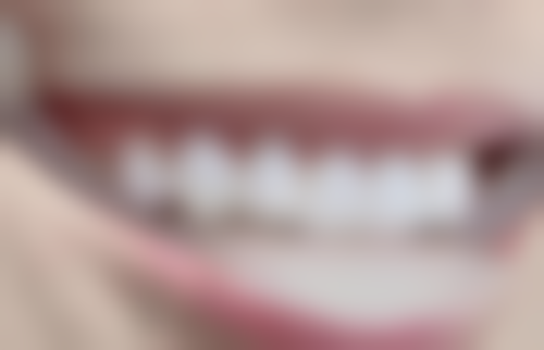 牙齿变脆易裂，后续维护麻烦