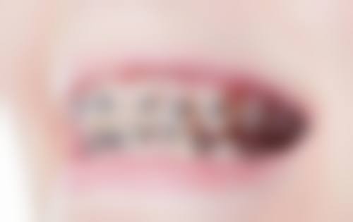 六、深圳蓝刺猬口腔收费价格表