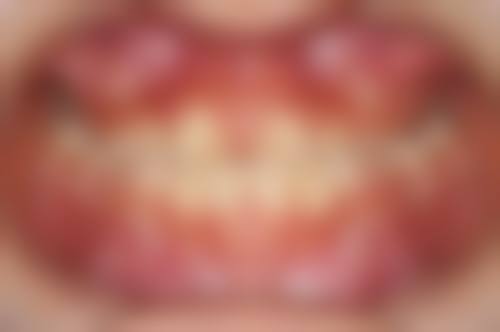 纠正不良习惯：改掉导致地包天的“小毛病”