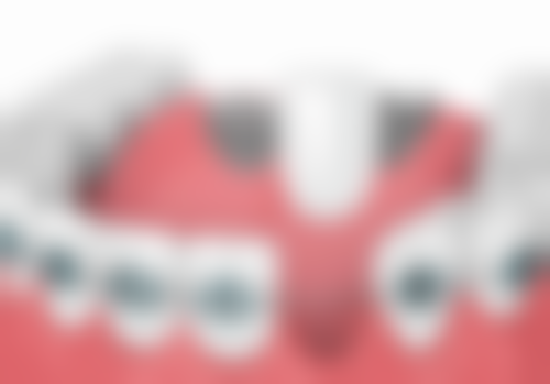 全瓷牙洗牙后的护理要点