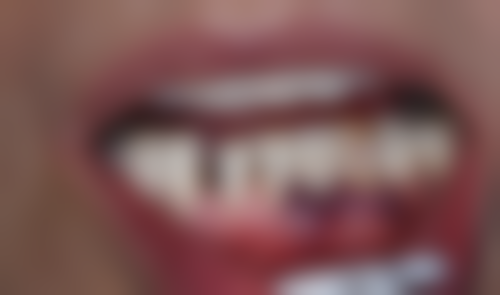 义乌活动义齿价格参考