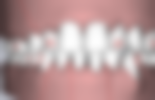 判断牙齿开裂的程度和位置