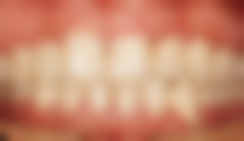 家用洗牙工具大揭秘：成效与局限并存