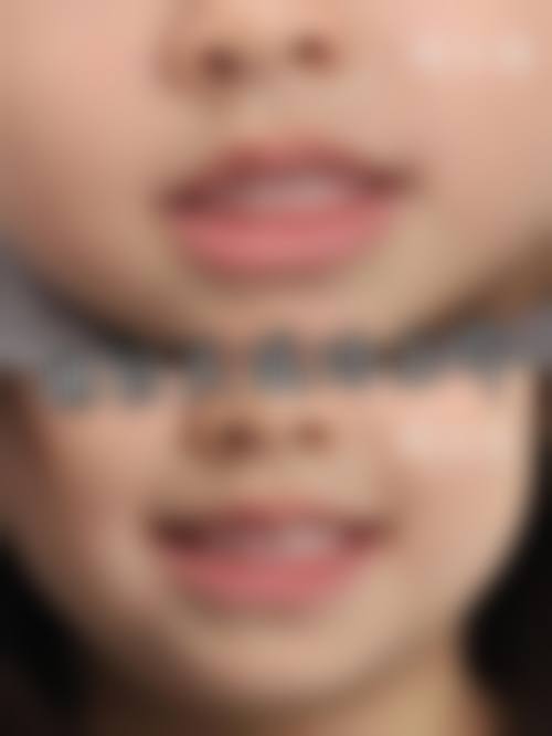 常见的地包天矫正方法大盘点