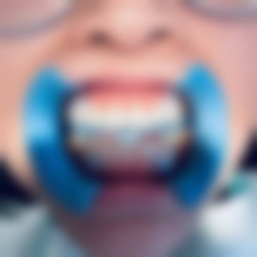 专精医疗手段：冷光美白与洗牙的神奇成效