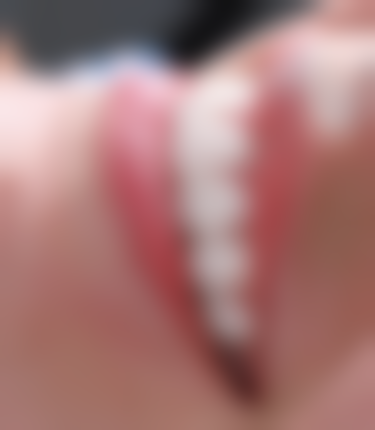 其他美白选择：美白贴片与树脂渗透美白