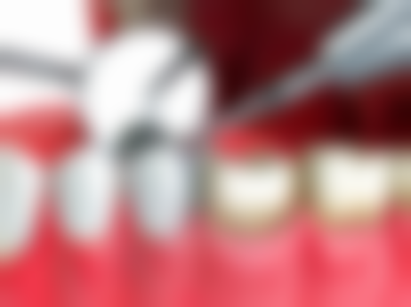 洗牙损伤全瓷牙的实例分析