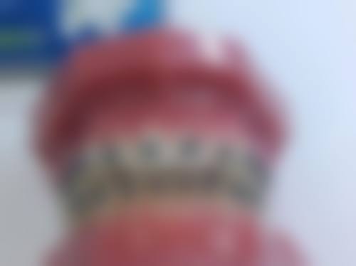 儿童牙齿矫正情况