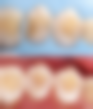 牙齿根管治疗侧穿了怎么办？先拍片评估，显微修补或根尖手术大多能保牙