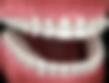 清洁消毒：减少侧穿后感染的风险