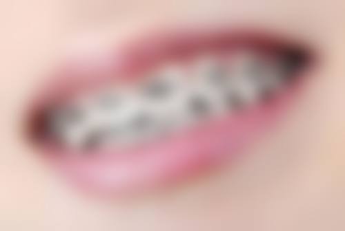 20岁可以种植牙齿吗？无禁忌就能做，颌骨已发育成熟适配种植牙