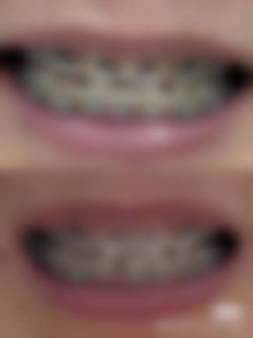 改变不良习惯，避免加重地包天