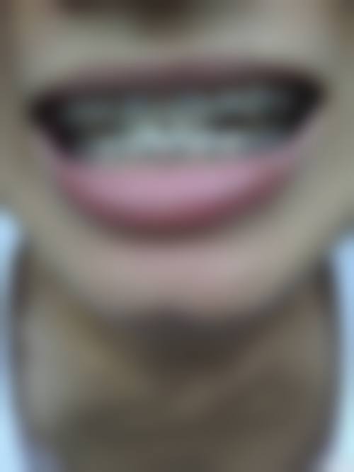 饮食调整与姿势保持，辅助矫正地包天