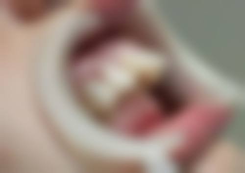 术后护理好坏对补牙后疼痛时长的意义