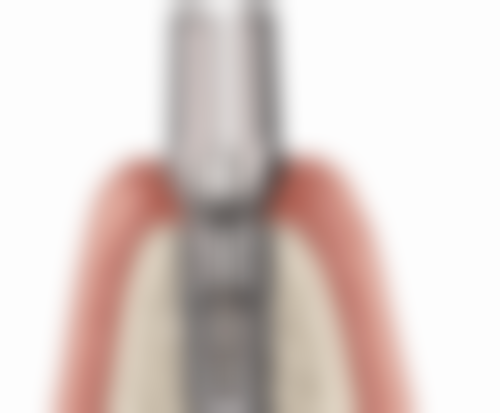 不痛的蛀牙可能的情况