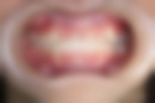 地包天怎么自己慢慢矫正？乳牙/替牙期可试咬撬法，配合纠正吐舌吮指等坏习惯