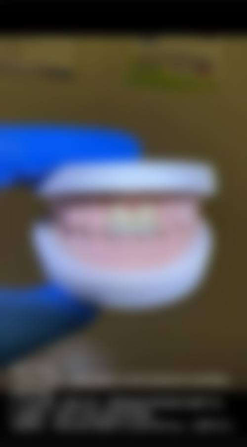 补牙和全瓷冠价格参考