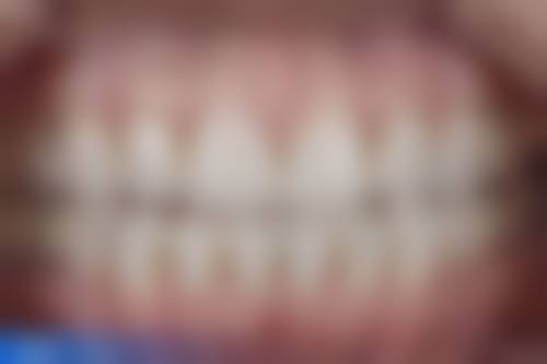 宁波不同医院种牙价格差异