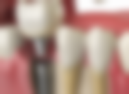 美观与耐用的平衡：烤瓷牙和全瓷牙的表现