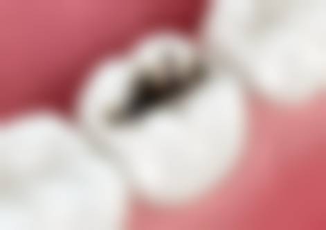 根管治疗第二次：术后注意事项全知道