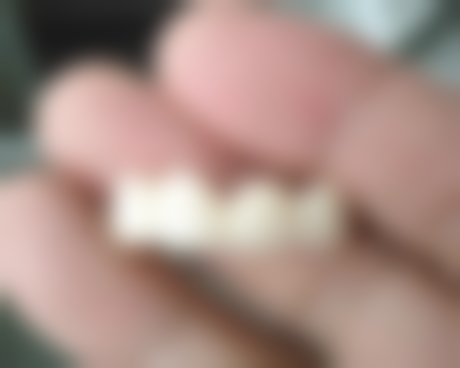 根管治疗中根管的清理——去除感染的“大扫除”