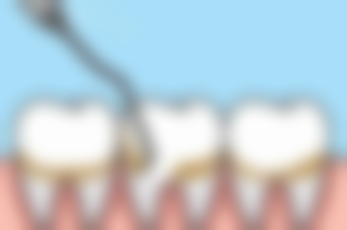 补牙治疗时，还得注意这些事儿！