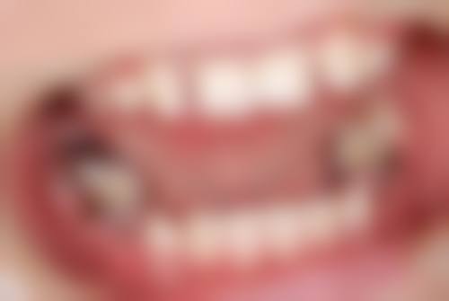 啥时候必须及时补牙呢？