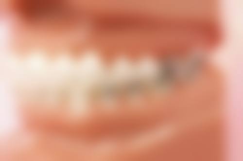 牙冠的种类及选择建议