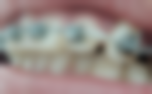 {辽宁义齿24小时在线咨询：吸附性义齿可上门制作，价优靠谱无套路