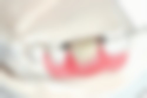 补牙后问题频发,再次补牙成必然?