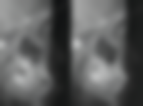 乳牙补牙,换牙后是否无需再补?