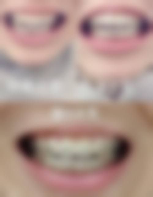 选择适合的矫正方法，让孩子拥有健康美牙