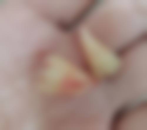 生理期补牙拔牙:特殊时期的注意事项