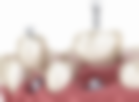 拔牙前后麻醉相关的注意事项