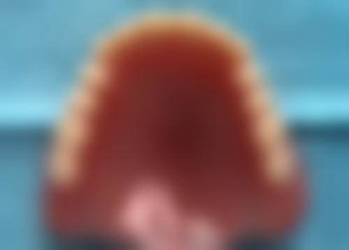 取下时机：出现这些状况建议拆除烤瓷牙