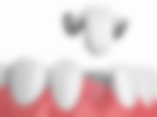 玻璃离子水门汀：预防龋齿的贴心之选