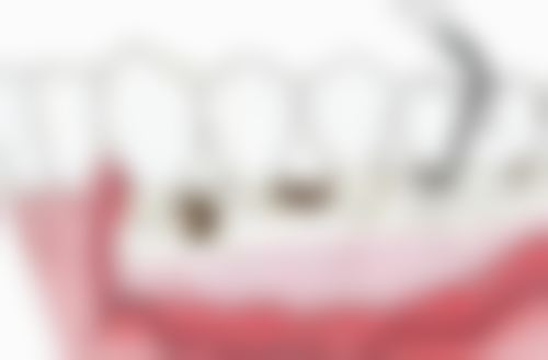 银汞合金：坚固耐用但美观欠佳的传统之选