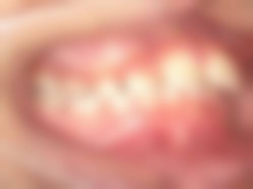 16岁矫正地包天，常见疑问解答