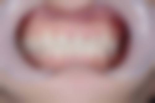 面部形态：直观反映地包天重度程度